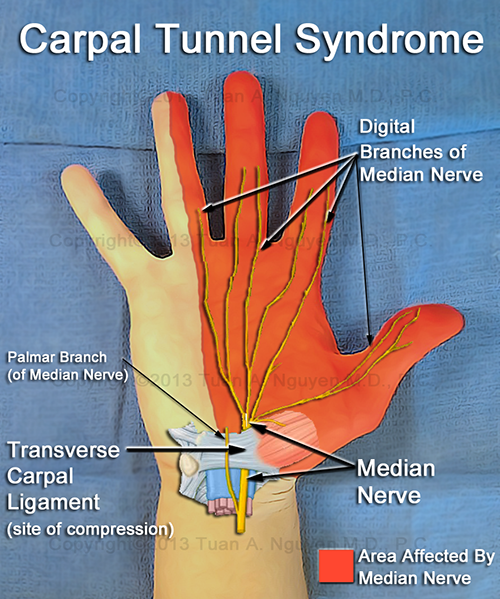 Carpal tunnel syndrome: MedlinePlus Medical Encyclopedia