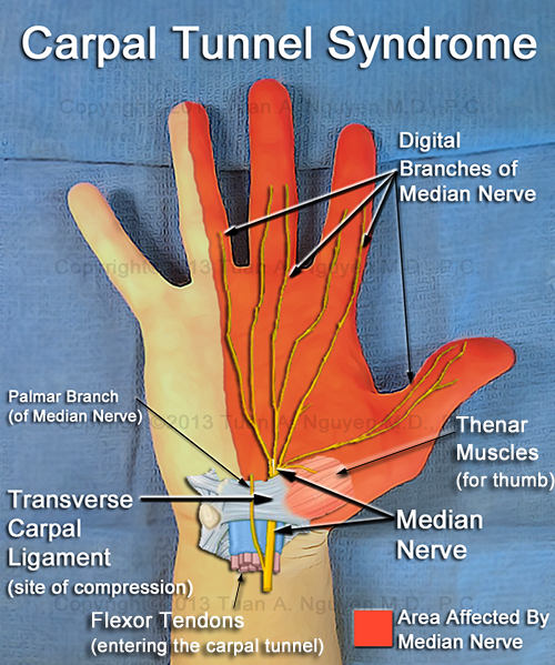 Carpal Tunnel Syndrome - Portland Lake Oswego Hand Surgery