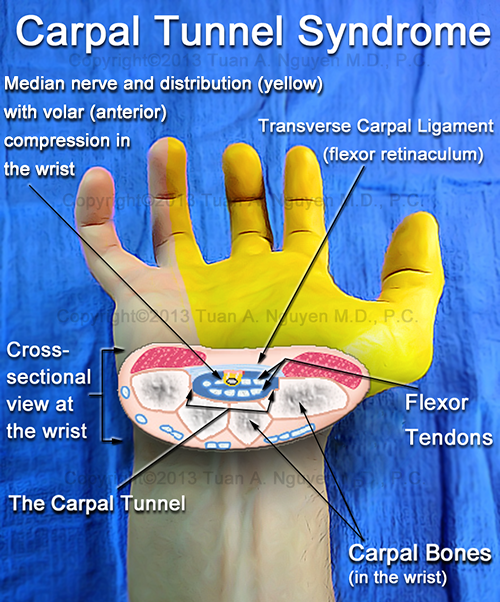 Cross-section of carpal tunnel at the wrist for carpal tunnel syndrome which open or endoscopic release can treat