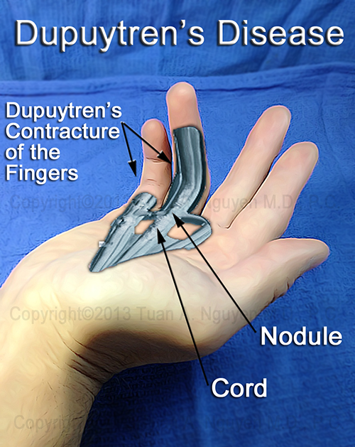 Dupuytren's Disease With Treatment By Needle Aponeurotomy at Lake Oswego Hand Surgery