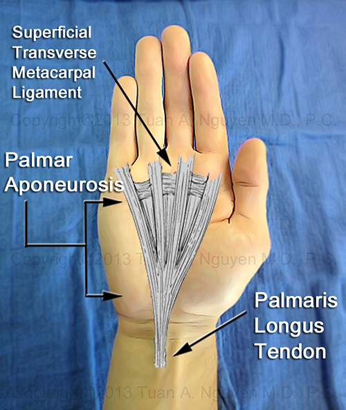 Dupuytren's Disease - Normal Anatomy and Location of Palmar Fascia