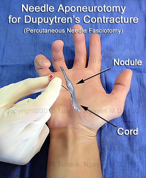 Needle Aponeurotomy for Dupuytren's Disease - Lake Oswego Hand Surgery