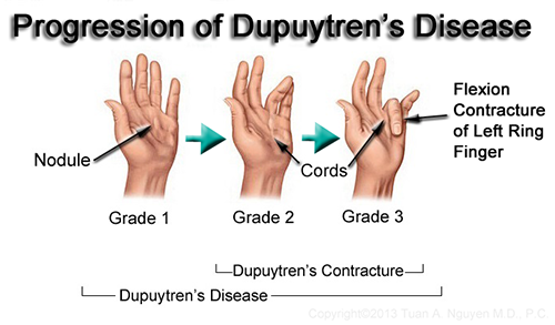 Dupuytren's Contracture Progression - Treatment By Needle Aponeurotomy