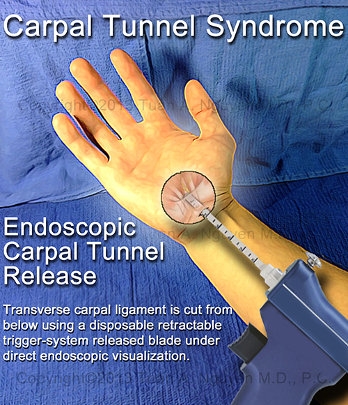 Portland Hand Surgery Endoscopic Carpal Tunnel Release for CTS with the Microaire ECTR SmartRelease