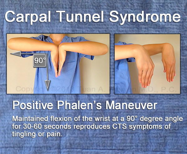 carpal tunnel self test