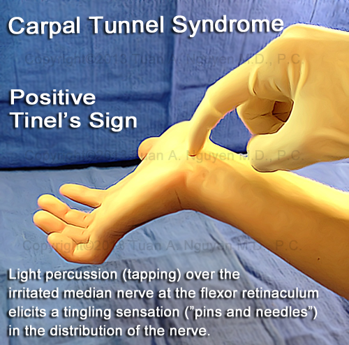 Median nerve injury, causes, symptoms, diagnosis and treatment